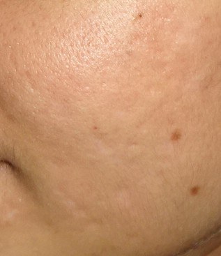 Acne — after