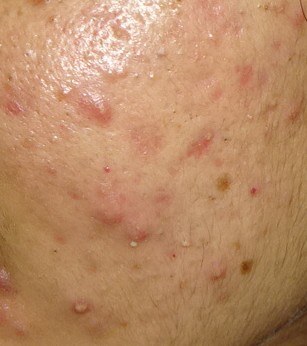 Acne — before